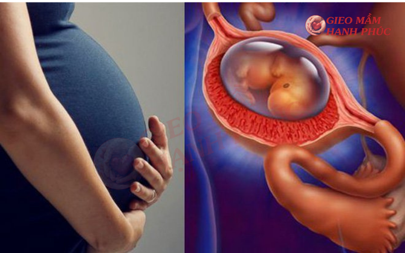 dấu hiệu mang thai ngoài tử cung tháng đầu